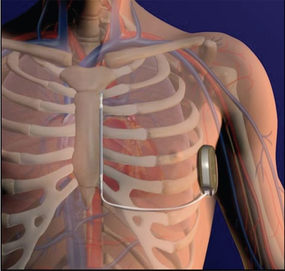 Image of optimal lead placement for S-ICD